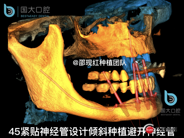 王月秀 下颌种植四颗 下颌骨严重萎缩.025.jpeg
