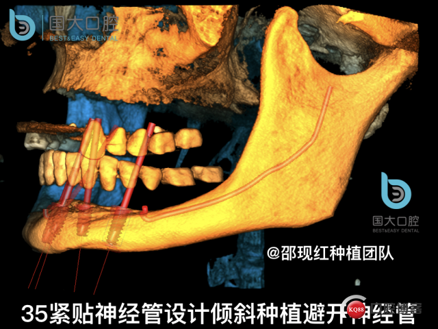 王月秀 下颌种植四颗 下颌骨严重萎缩.026.jpeg