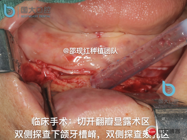 王月秀 下颌种植四颗 下颌骨严重萎缩.027.jpeg