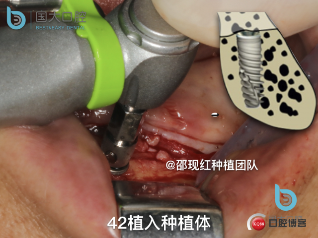 王月秀 下颌种植四颗 下颌骨严重萎缩.030.jpeg