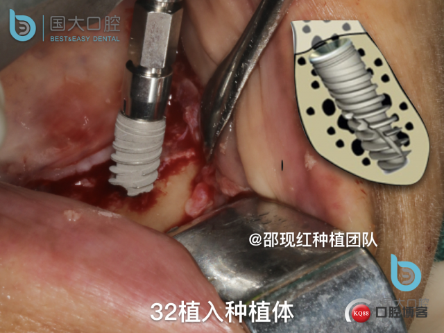 王月秀 下颌种植四颗 下颌骨严重萎缩.031.jpeg