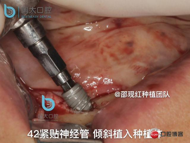 王月秀 下颌种植四颗 下颌骨严重萎缩.034.jpeg
