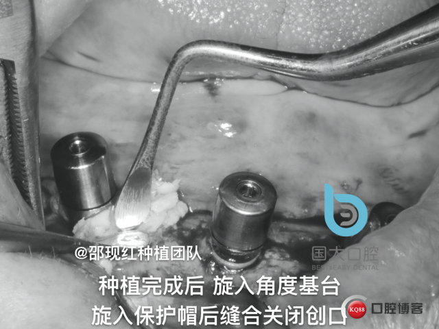 王月秀 下颌种植四颗 下颌骨严重萎缩.035.jpeg