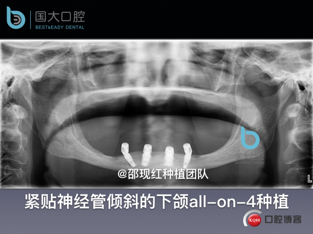 王月秀 下颌种植四颗 下颌骨严重萎缩.036.jpeg