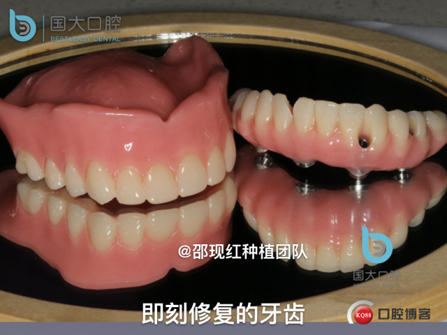 王月秀 下颌种植四颗 下颌骨严重萎缩.037.jpeg