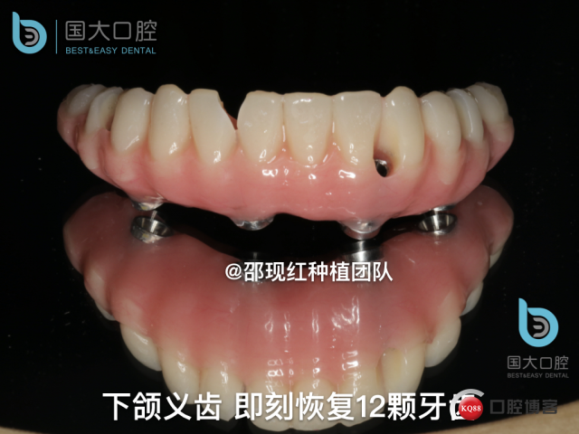 王月秀 下颌种植四颗 下颌骨严重萎缩.039.jpeg