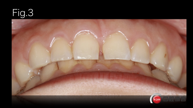 veneers  CASE_Styleitaliano_的副本2.012.jpeg