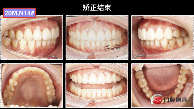 刘欢，推磨牙图片输出.047.jpeg