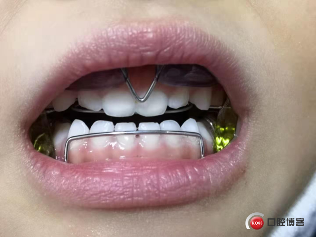 佩戴后.jpg