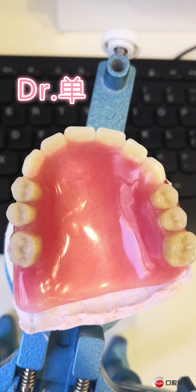 上颌模型戴牙照_meitu_4.jpg