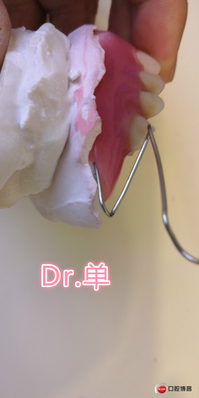 上颌右上游离端不密合_meitu_8.jpg