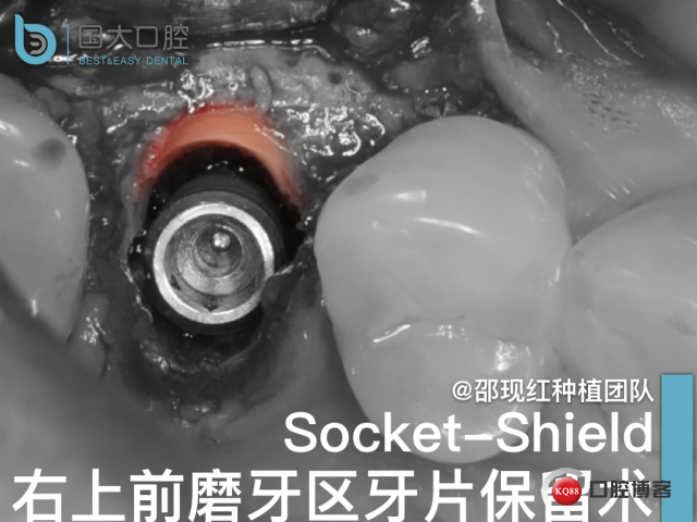孔叶文 右上5牙片保留术.001.jpeg