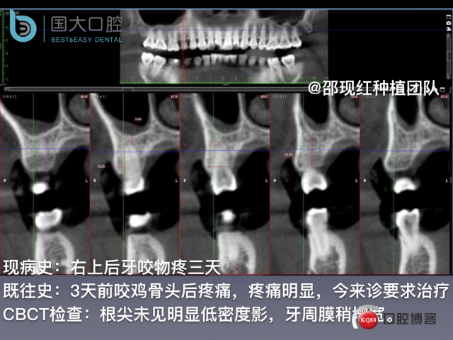 孔叶文 右上5牙片保留术.002.jpeg