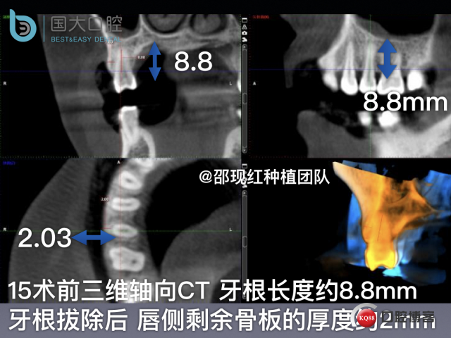 孔叶文 右上5牙片保留术.003.jpeg