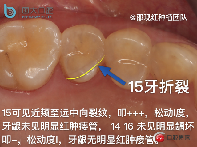孔叶文 右上5牙片保留术.004.jpeg