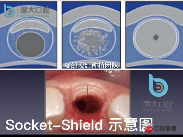 孔叶文 右上5牙片保留术.010.jpeg