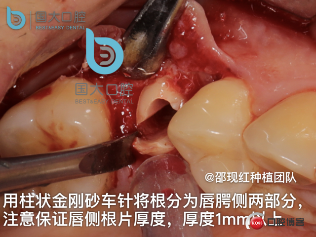 孔叶文 右上5牙片保留术.013.jpeg