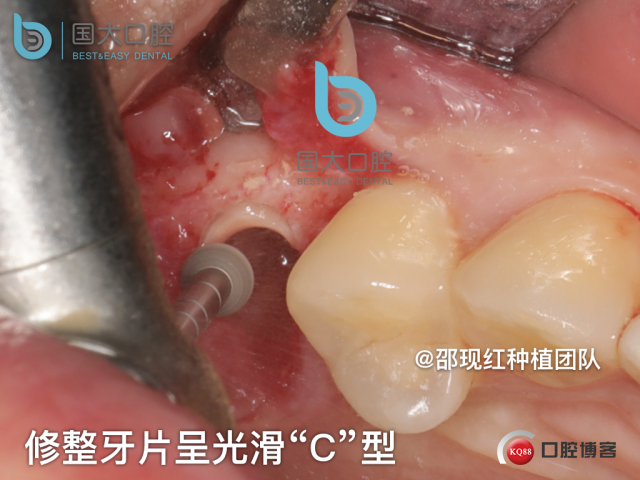 孔叶文 右上5牙片保留术.016.jpeg