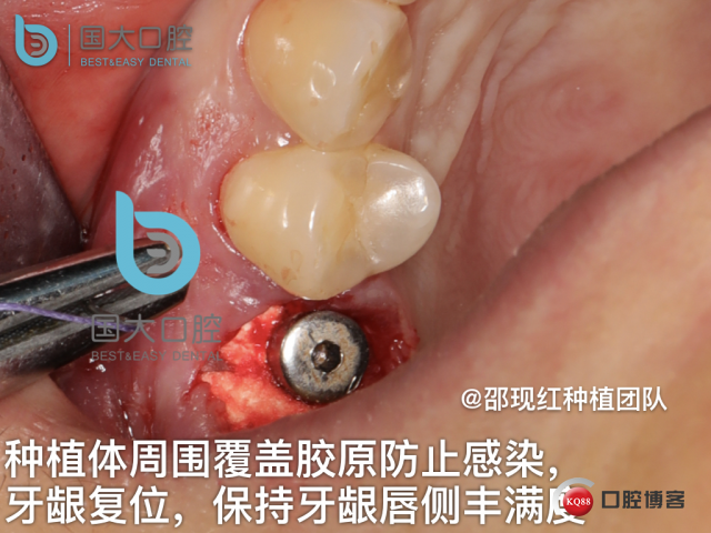 孔叶文 右上5牙片保留术.032.jpeg