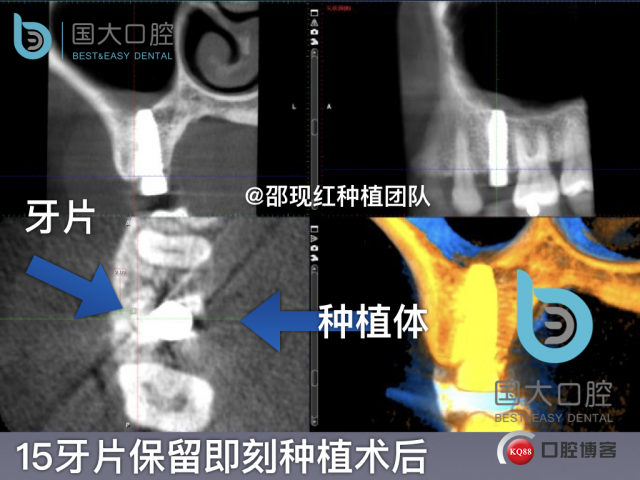 孔叶文 右上5牙片保留术.035.jpeg