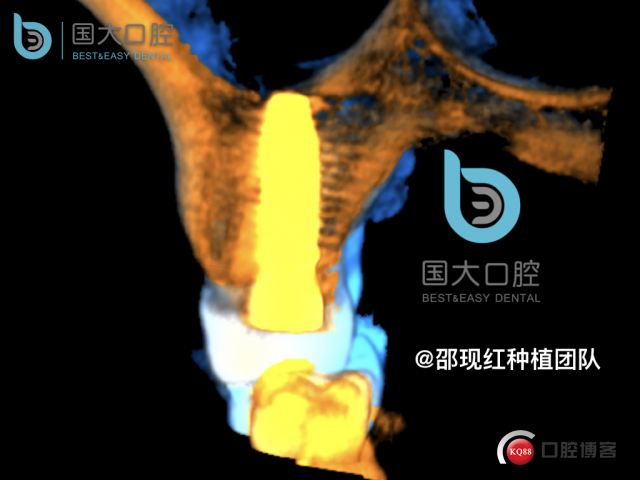 孔叶文 右上5牙片保留术.036.jpeg