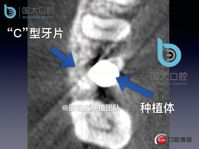 孔叶文 右上5牙片保留术.037.jpeg