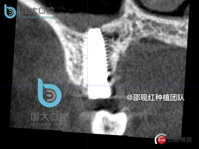 孔叶文 右上5牙片保留术.038.jpeg