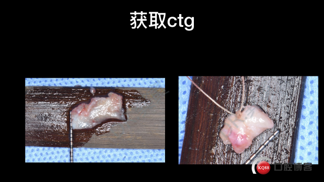 张志修牙龈瘤+龈乳头重建.008.jpeg