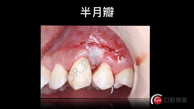 张志修牙龈瘤+龈乳头重建.013.jpeg