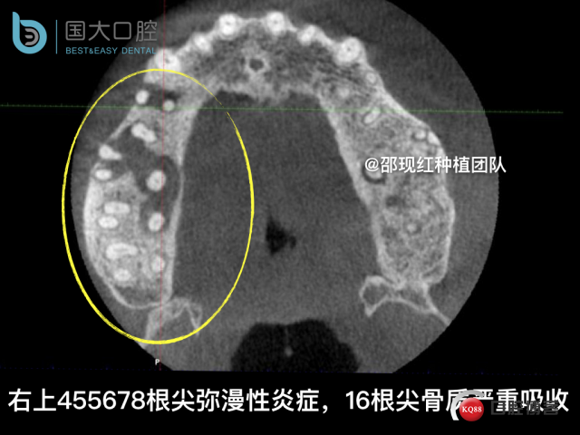 毛登焕 右上458即刻种植 bb种植 18倾斜种植 植骨术 骨胶原 植骨术 牙龈情况.003.jpeg