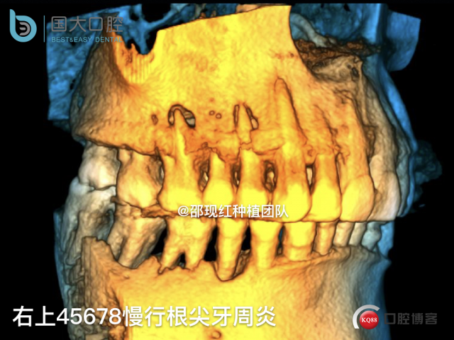 毛登焕 右上458即刻种植 bb种植 18倾斜种植 植骨术 骨胶原 植骨术 牙龈情况.004.jpeg