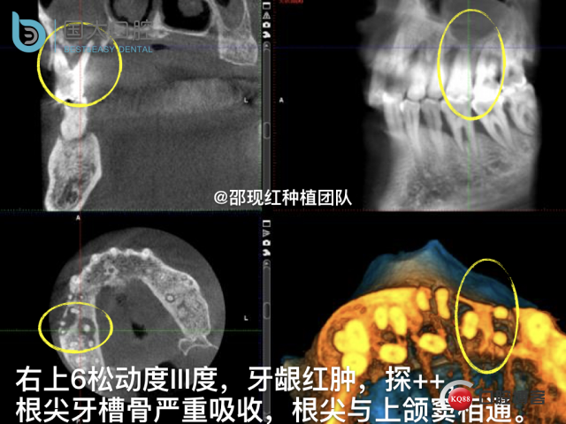 毛登焕 右上458即刻种植 bb种植 18倾斜种植 植骨术 骨胶原 植骨术 牙龈情况.006.jpeg