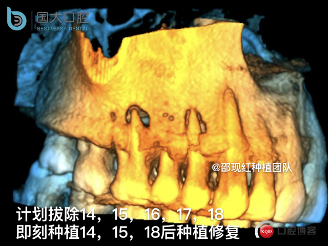 毛登焕 右上458即刻种植 bb种植 18倾斜种植 植骨术 骨胶原 植骨术 牙龈情况.010.jpeg