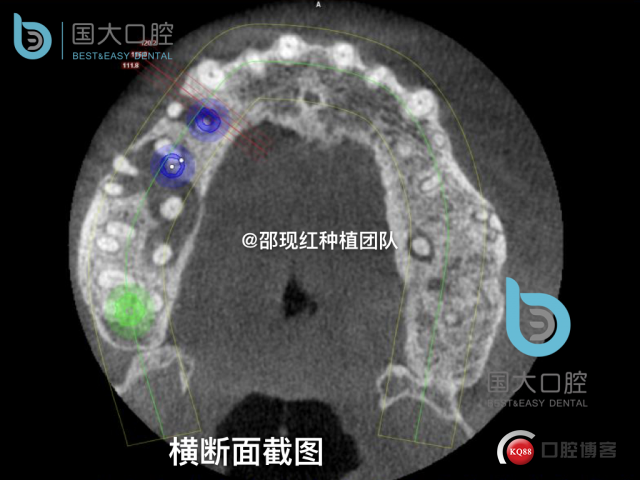 毛登焕 右上458即刻种植 bb种植 18倾斜种植 植骨术 骨胶原 植骨术 牙龈情况.012.jpeg