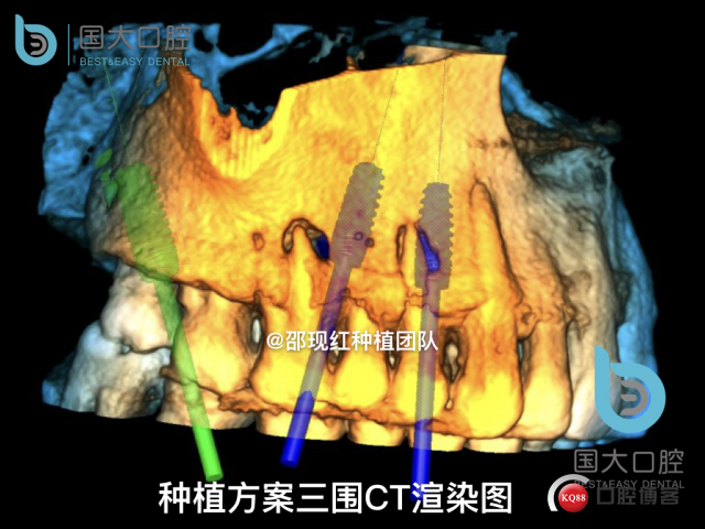毛登焕 右上458即刻种植 bb种植 18倾斜种植 植骨术 骨胶原 植骨术 牙龈情况.013.jpeg