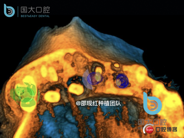 毛登焕 右上458即刻种植 bb种植 18倾斜种植 植骨术 骨胶原 植骨术 牙龈情况.014.jpeg