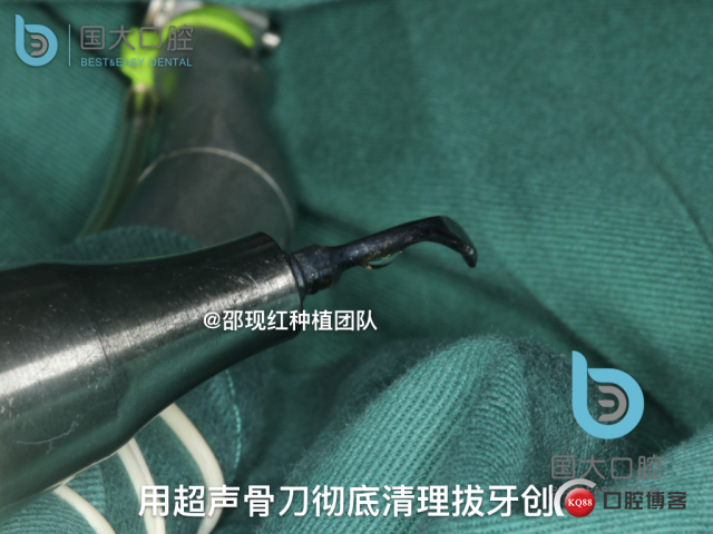 毛登焕 右上458即刻种植 bb种植 18倾斜种植 植骨术 骨胶原 植骨术 牙龈情况.023.jpeg