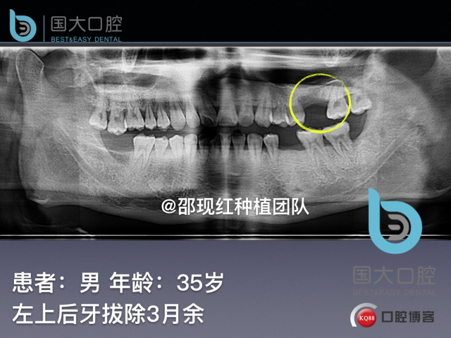 王元超 左上6上颌窦外提升 骨粉植骨术.002.jpeg