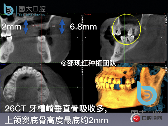 王元超 左上6上颌窦外提升 骨粉植骨术.007.jpeg