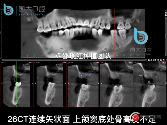 王元超 左上6上颌窦外提升 骨粉植骨术.009.jpeg