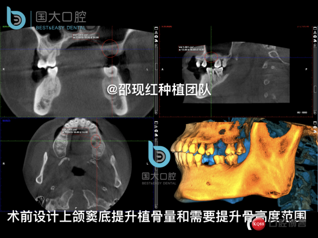 王元超 左上6上颌窦外提升 骨粉植骨术.011.jpeg