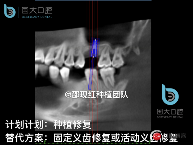 王元超 左上6上颌窦外提升 骨粉植骨术.012.jpeg