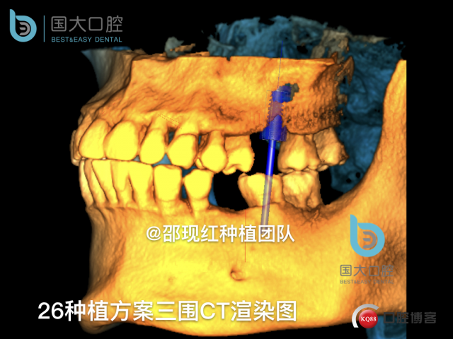 王元超 左上6上颌窦外提升 骨粉植骨术.013.jpeg