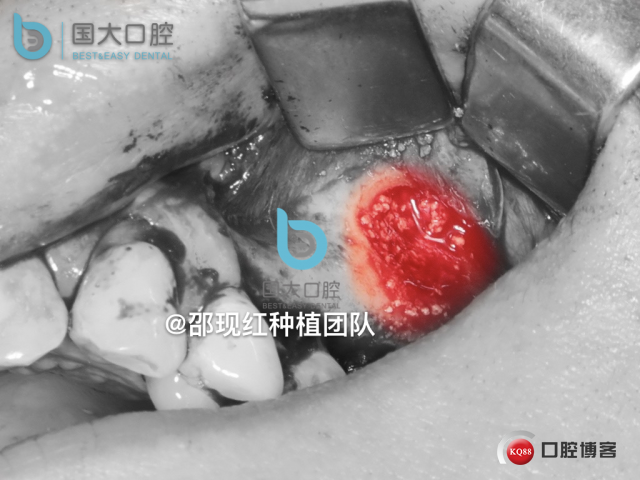 王元超 左上6上颌窦外提升 骨粉植骨术.020.jpeg