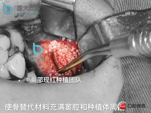 王元超 左上6上颌窦外提升 骨粉植骨术.021.jpeg