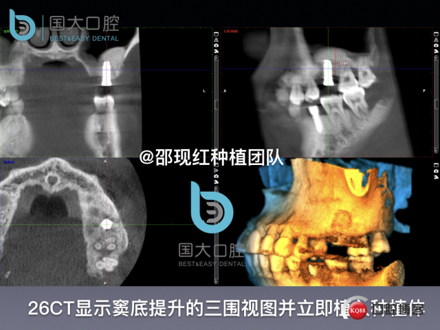王元超 左上6上颌窦外提升 骨粉植骨术.025.jpeg