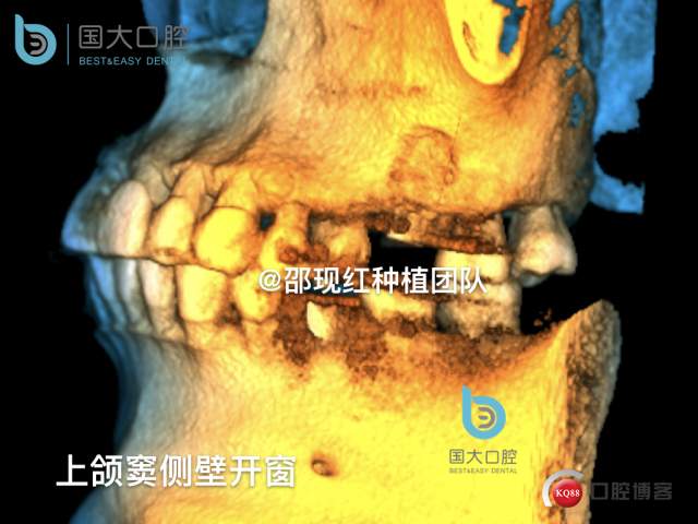 王元超 左上6上颌窦外提升 骨粉植骨术.026.jpeg