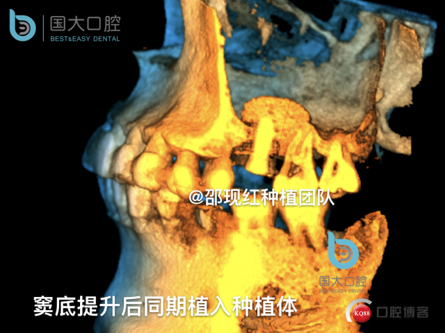 王元超 左上6上颌窦外提升 骨粉植骨术.027.jpeg