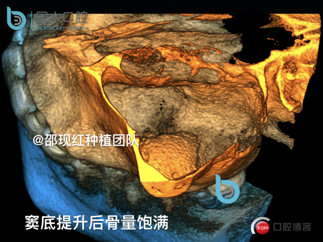 王元超 左上6上颌窦外提升 骨粉植骨术.028.jpeg