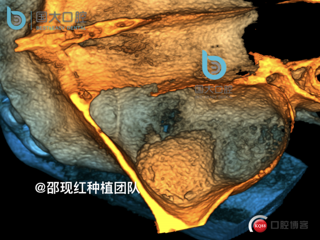 王元超 左上6上颌窦外提升 骨粉植骨术.030.jpeg
